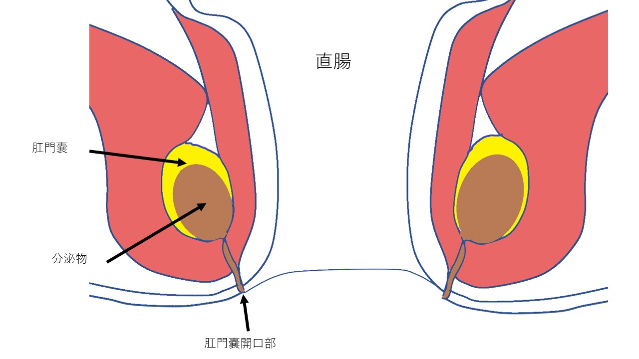 アヌス 栓